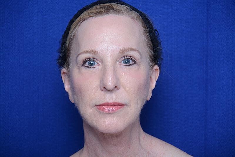 Upper Blepharoplasty Before & After
