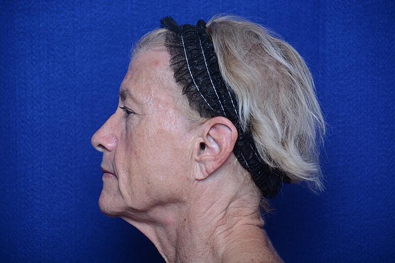 Upper Blepharoplasty Before & After