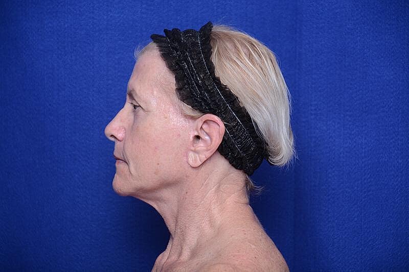 Upper Blepharoplasty Before & After