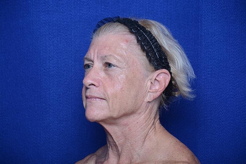 Upper Blepharoplasty Before & After