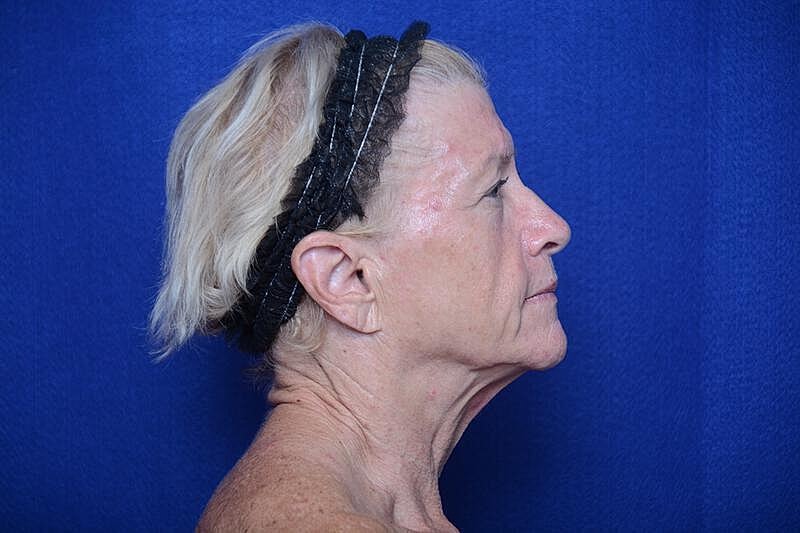 Upper Blepharoplasty Before & After