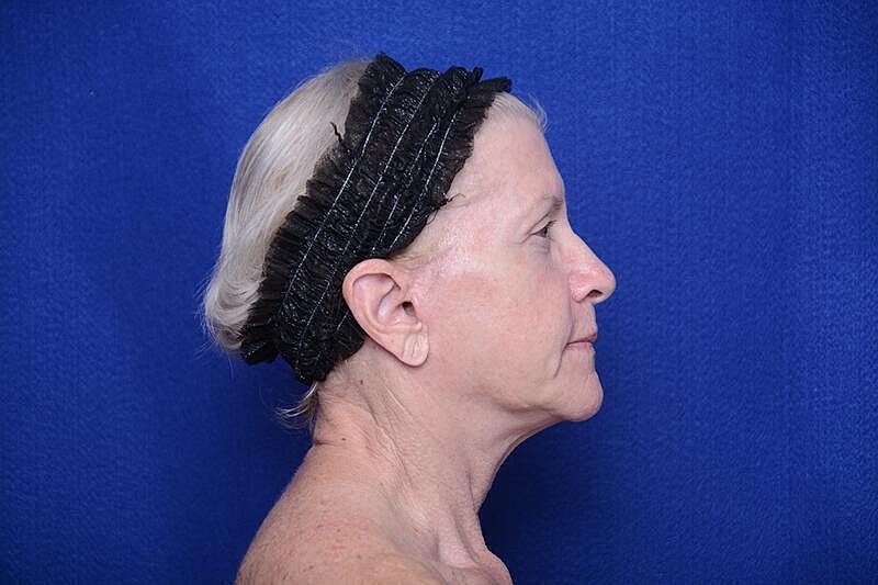 Upper Blepharoplasty Before & After