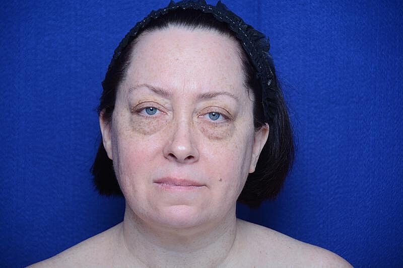 Upper Blepharoplasty Before & After