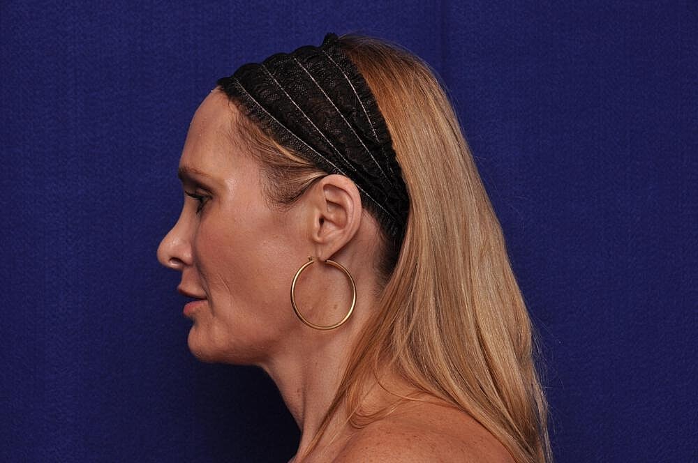 Upper Blepharoplasty Before & After