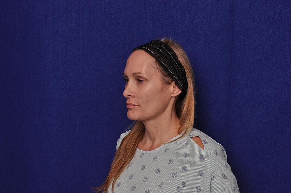 Upper Blepharoplasty Before & After