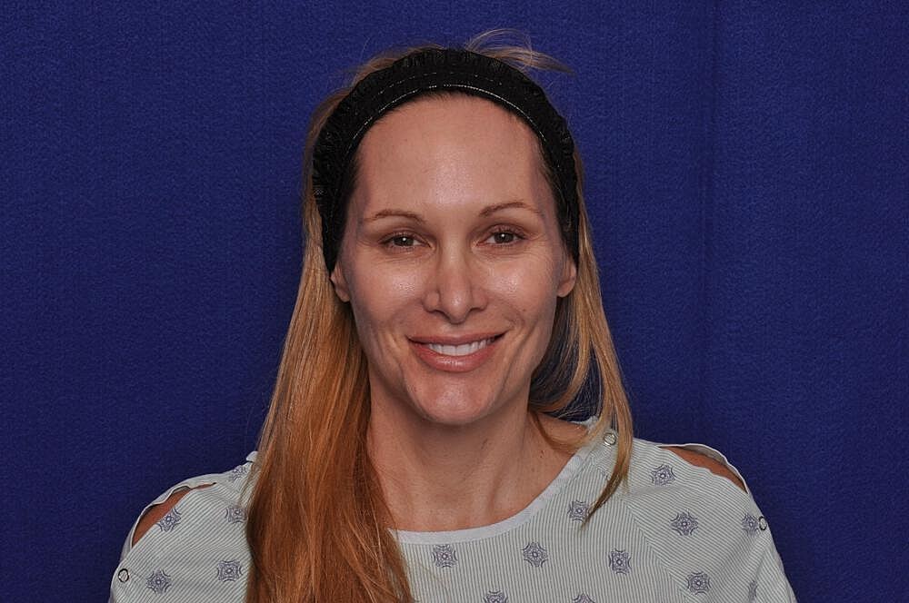 Upper Blepharoplasty Before & After