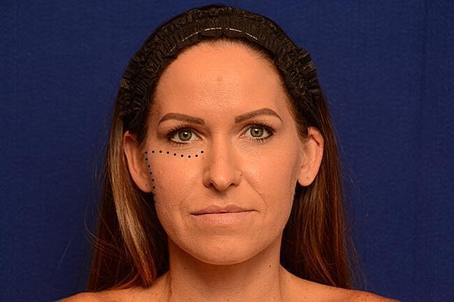 Injectable Cheek Lift Before & After