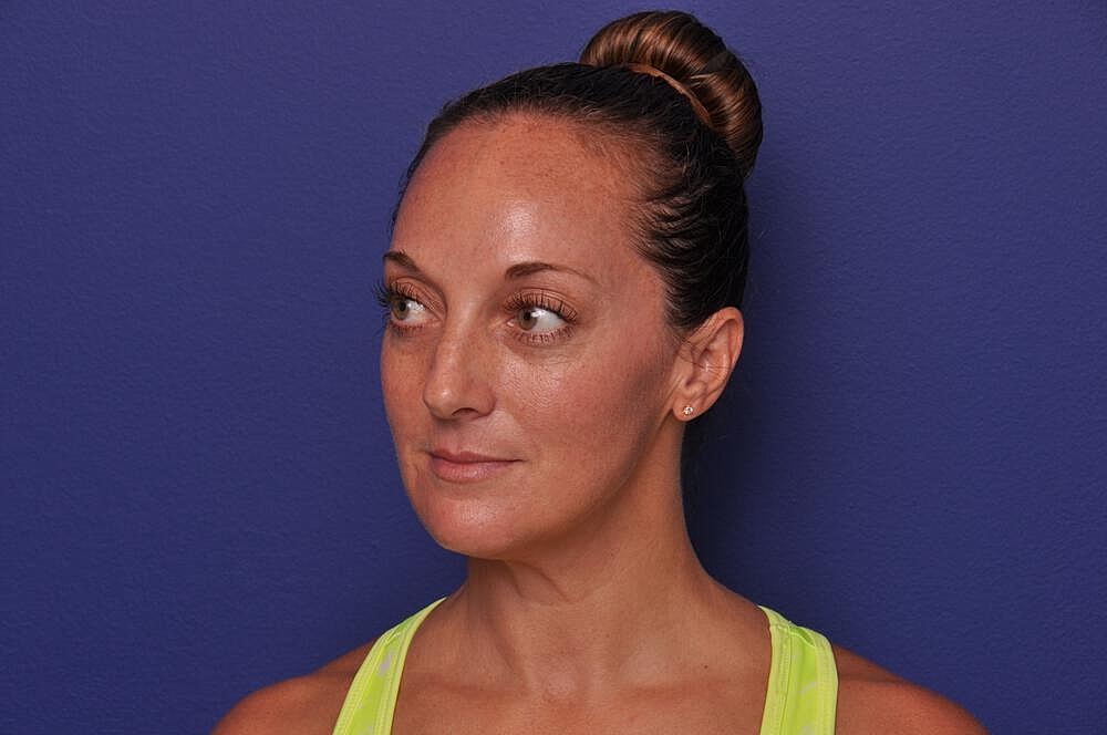 Injectable Cheek Lift Before & After