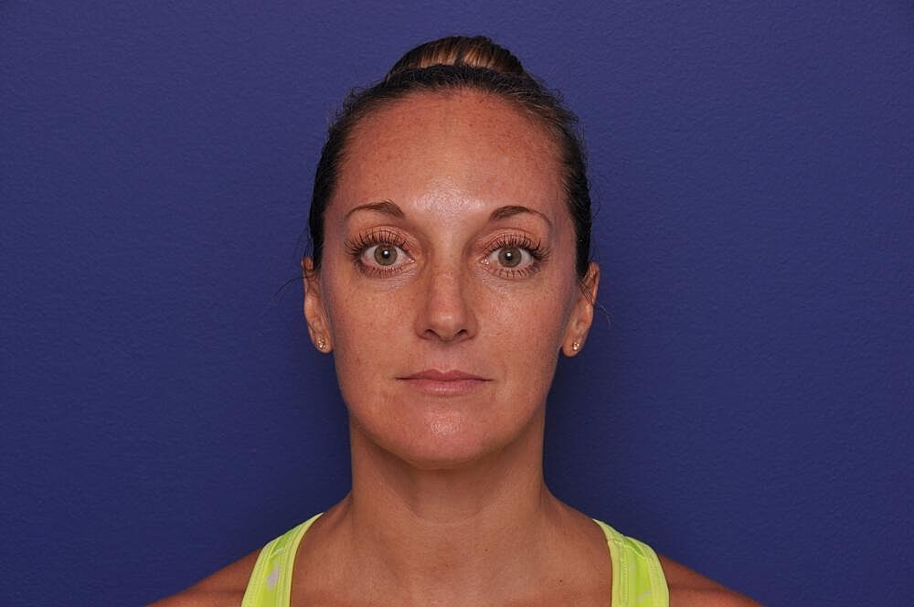 Injectable Cheek Lift Before & After