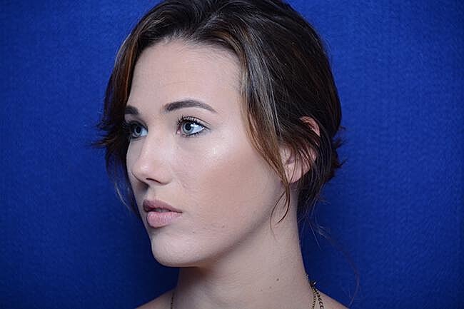 Injectable Cheek Lift Before & After