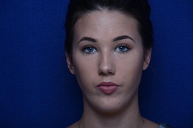 Injectable Cheek Lift Before & After