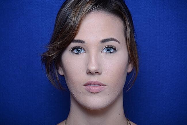 Injectable Cheek Lift Before & After