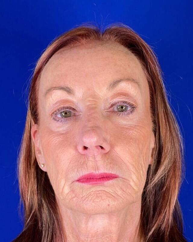Injectable Cheek Lift Before & After