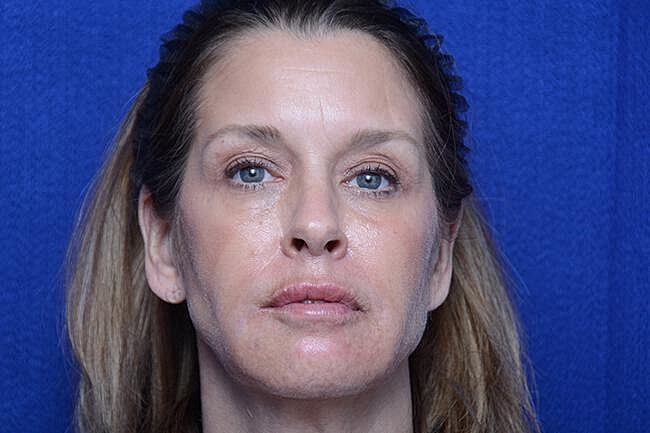 Lower Blepharoplasty Before & After