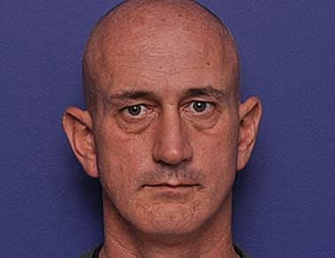 Lower Blepharoplasty Before & After