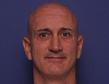 Lower Blepharoplasty Before & After