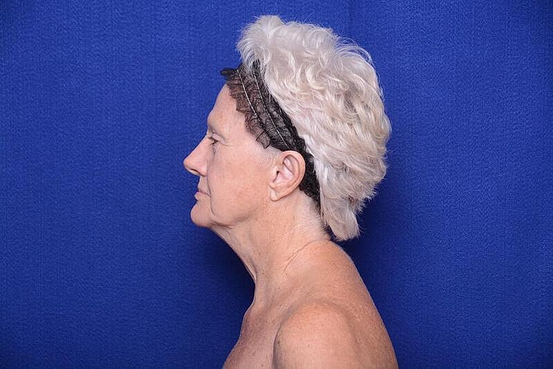 Lower Blepharoplasty Before & After