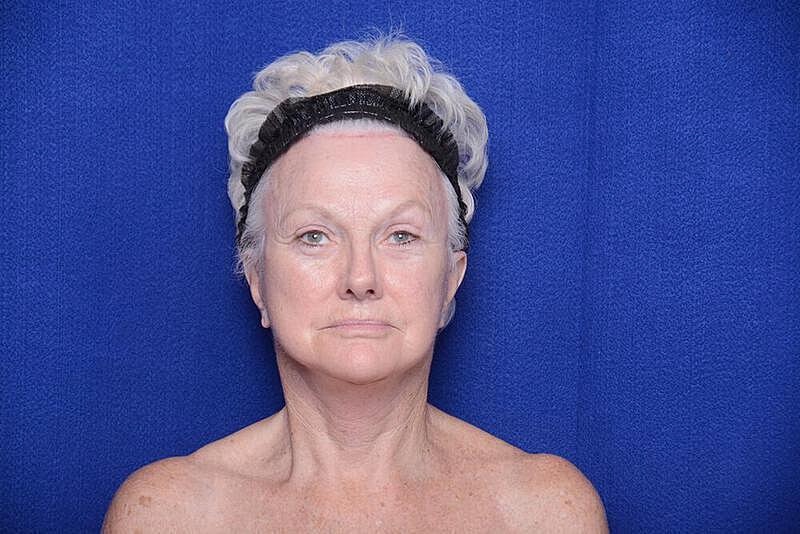 Lower Blepharoplasty Before & After