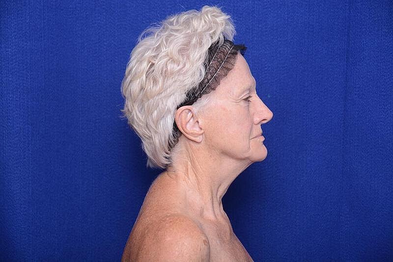 Lower Blepharoplasty Before & After