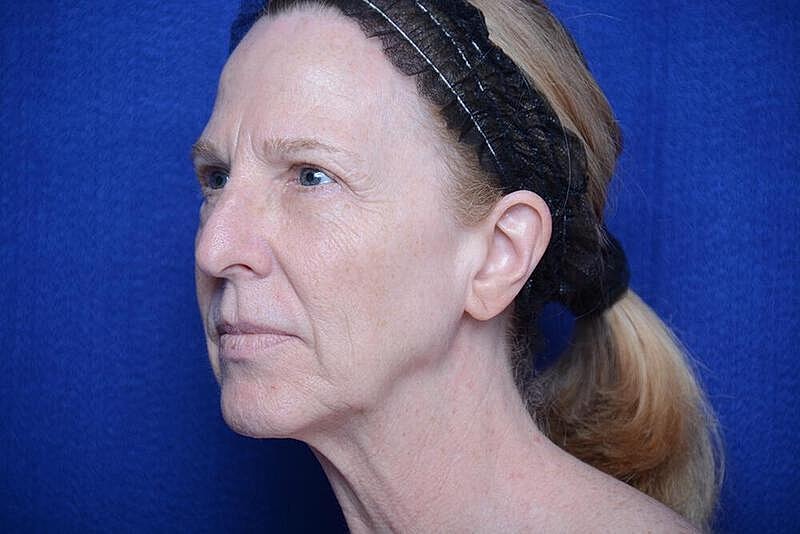 Lower Blepharoplasty Before & After