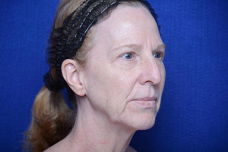 Lower Blepharoplasty Before & After