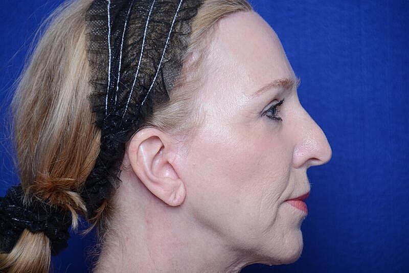 Lower Blepharoplasty Before & After