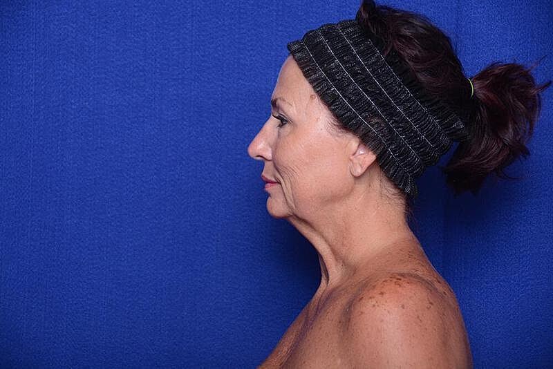 Lower Blepharoplasty Before & After