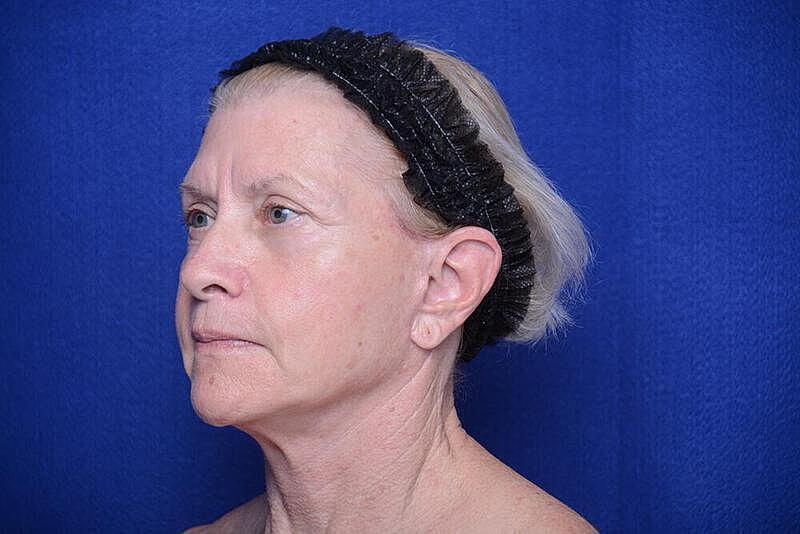 Lower Blepharoplasty Before & After