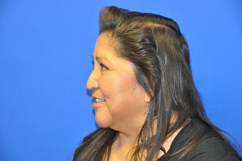 Lower Blepharoplasty Before & After