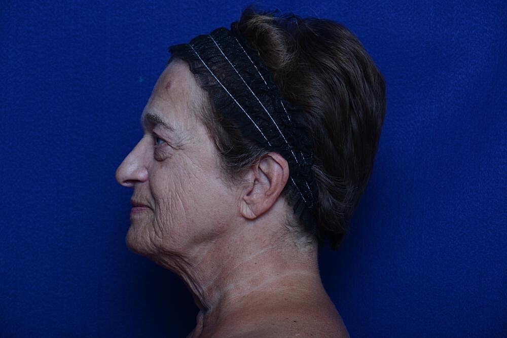 Lower Blepharoplasty Before & After