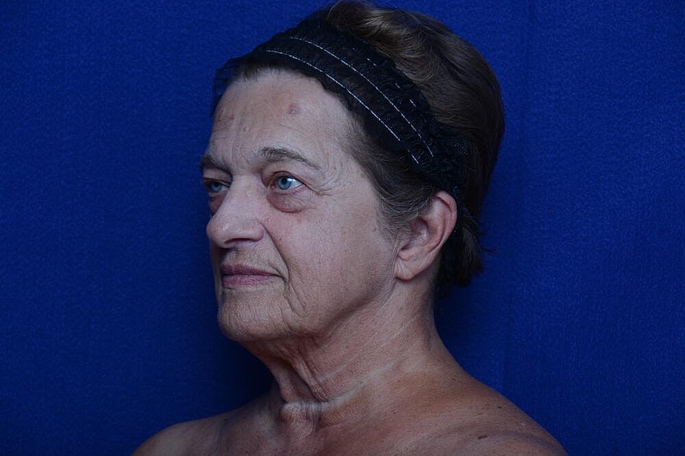 Lower Blepharoplasty Before & After