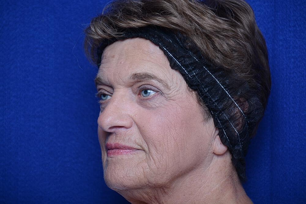 Lower Blepharoplasty Before & After