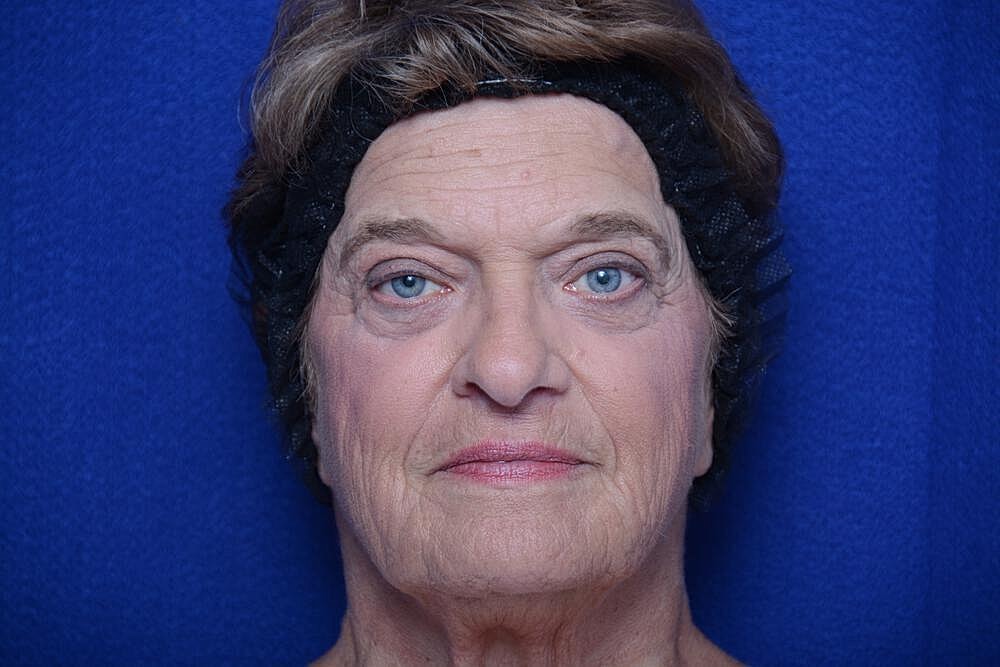 Lower Blepharoplasty Before & After