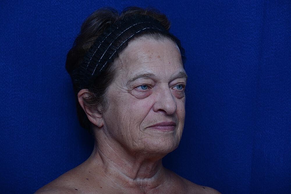 Lower Blepharoplasty Before & After