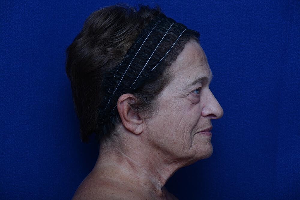 Lower Blepharoplasty Before & After