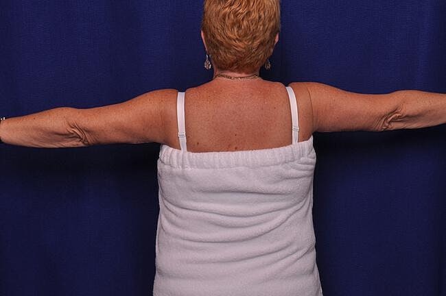 Arm Lift Before & After