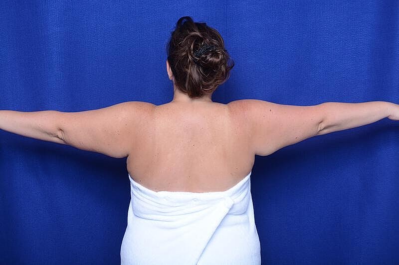 Arm Lift Before & After