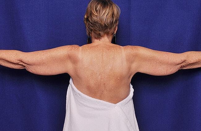 Arm Lift Before & After