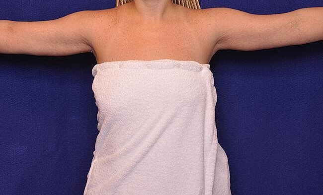 Arm Lift Before & After