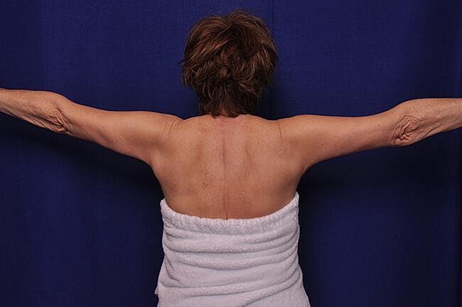 Arm Lift Before & After