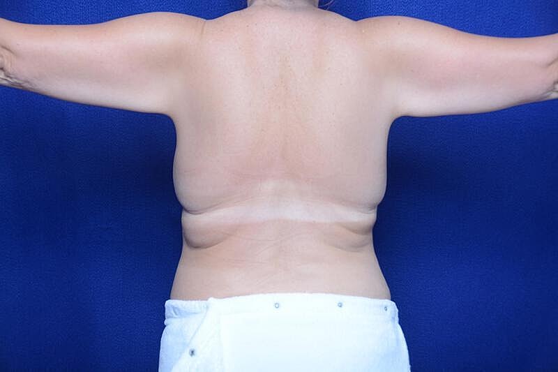 Arm Lift Before & After