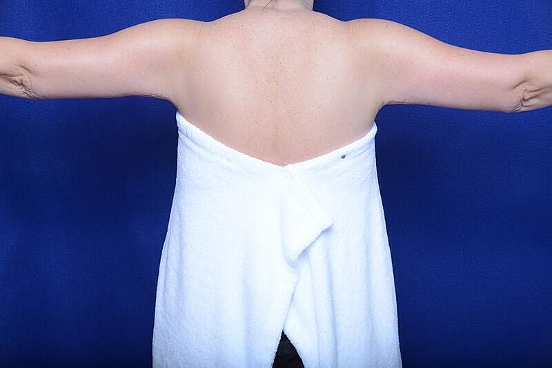 Arm Lift Before & After