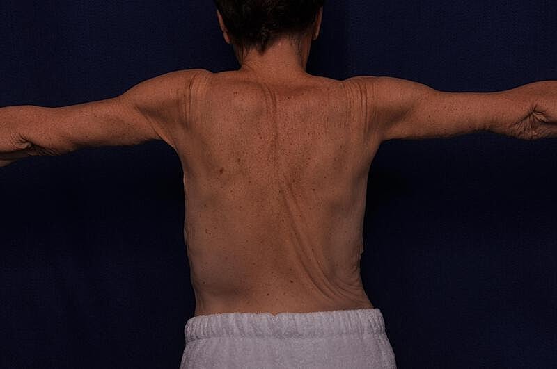 Arm Lift Before & After